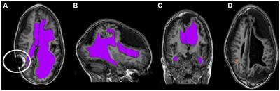 Evaluating normalized registration and preprocessing methodologies for the analysis of brain MRI in pediatric patients with shunt-treated hydrocephalus